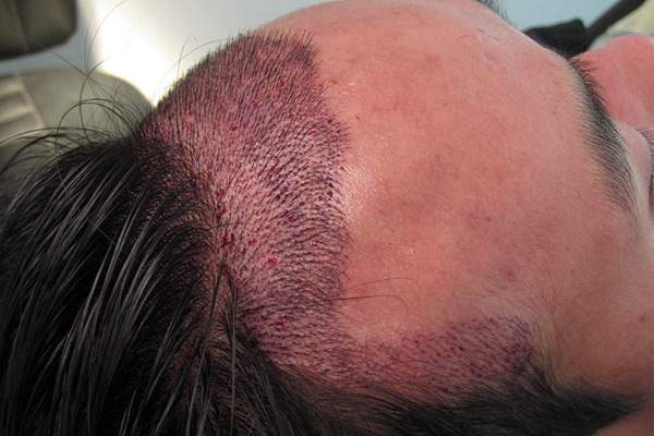 Hair Transplant surgery kills Chennai student