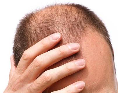 27-year-old Software Engineer Commits Suicide Hair Fall