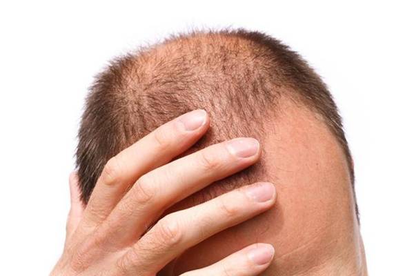 27-year-old Software Engineer Commits Suicide Hair Fall