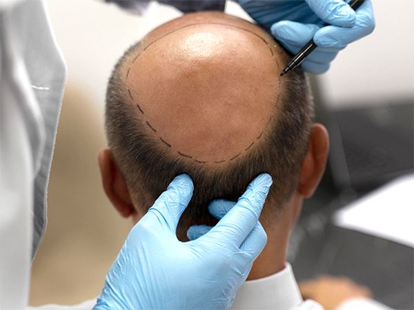 Deadly Hair Transplant