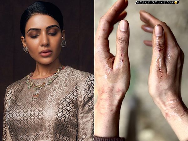Samantha_RuthPrabhu_Injured