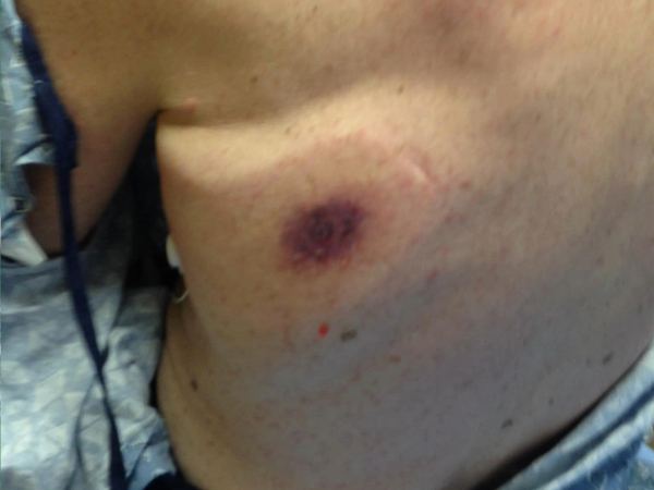 Man Eating Bacteria Ate 8 People