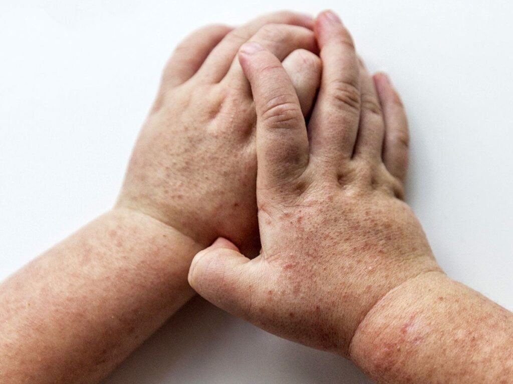 Scarlet Fever Hyderabad