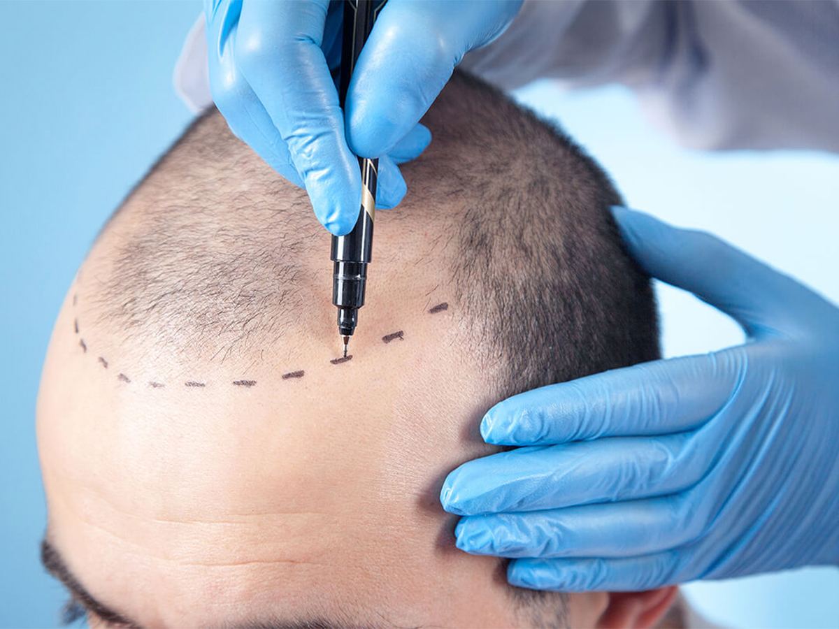 Hair Transplant Horror