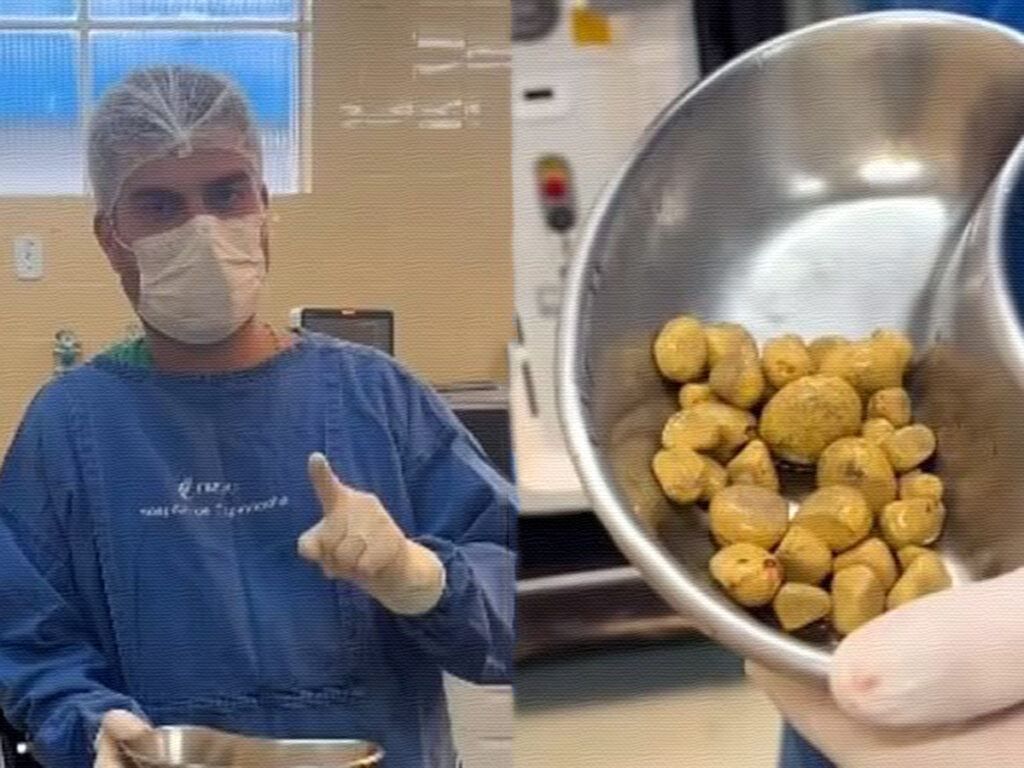 shocking-kidney-disaster-35-stones-from-coca-cola